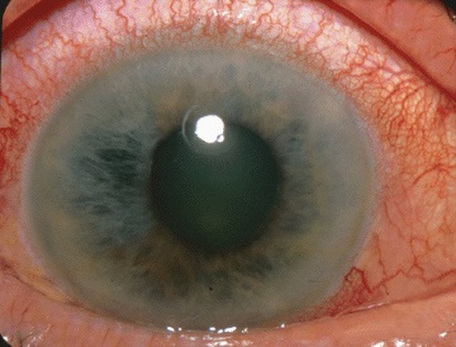 extreme close up of a cloudy eye with glaucoma
