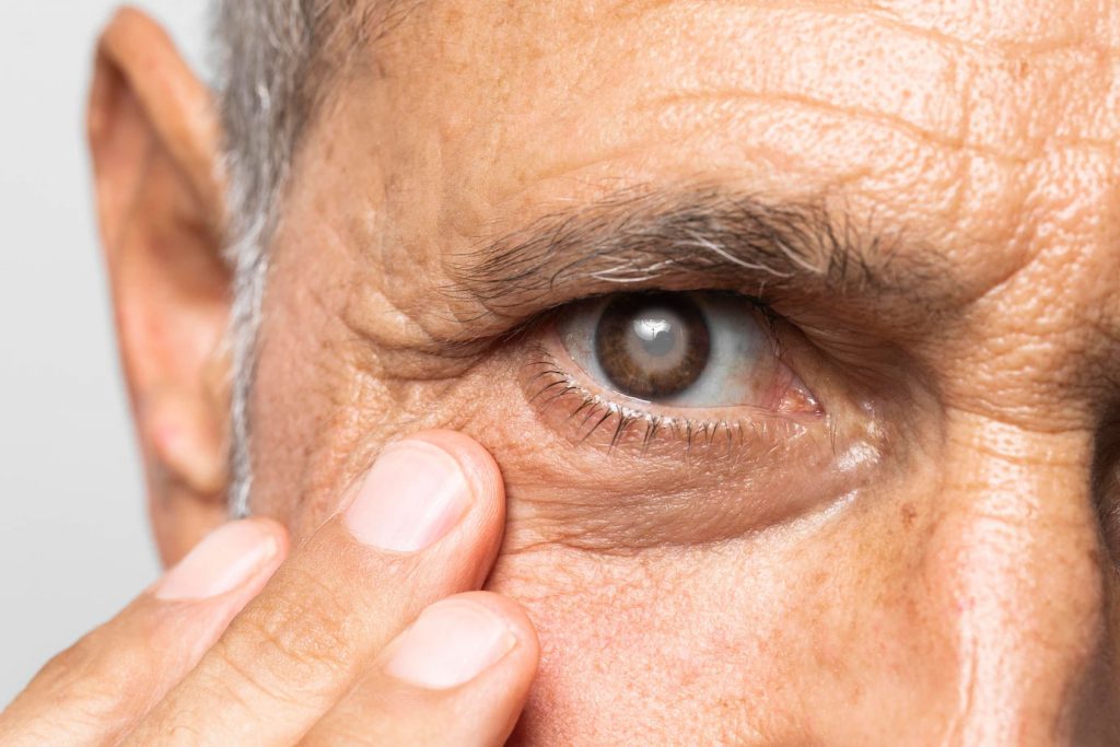 closeup of an older man's eye with a cloudy film over the center