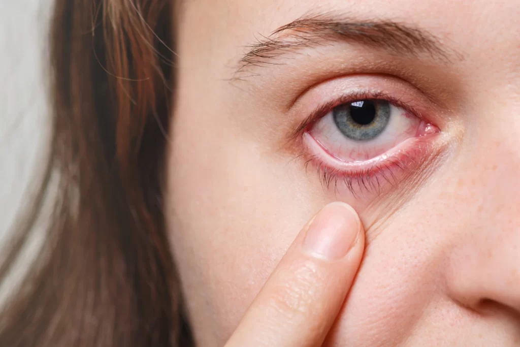 close up of a woman with a bloodsshot eye pulling down her lower eyelid